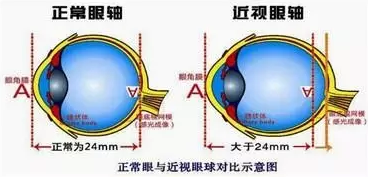 近視眼球突出？！控制近視度數加深是關鍵！