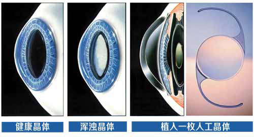 ICL晶體植入術——高度近視優選方式