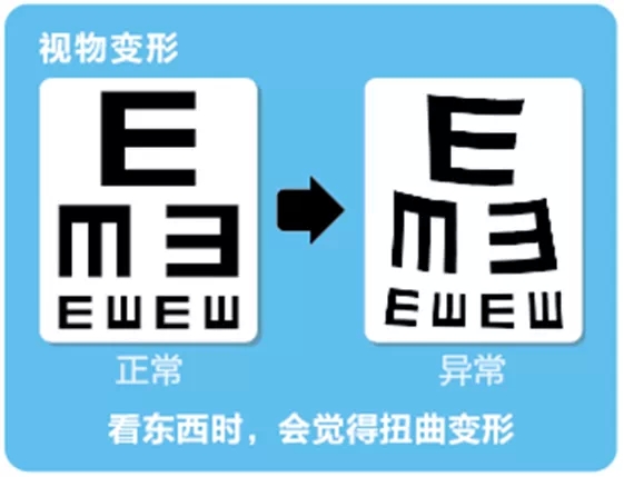 視網膜脫離啥癥狀？這張圖告訴你！