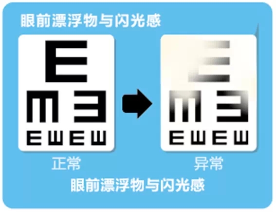 視網膜脫離啥癥狀？這張圖告訴你！