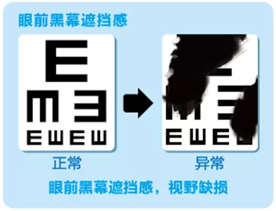 視網膜脫離啥癥狀？這張圖告訴你！