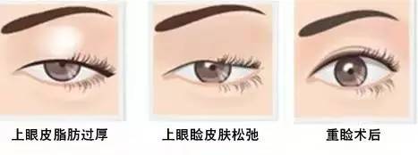 為什么要做雙眼皮？5個理由說服你！