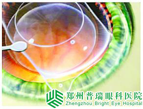 【專家解讀】近視手術的安心性