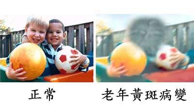 黃斑變性與老花眼，兩者不一樣！