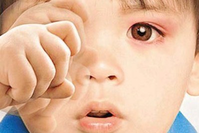 秋季紅眼病高發，當心孩子被傳染