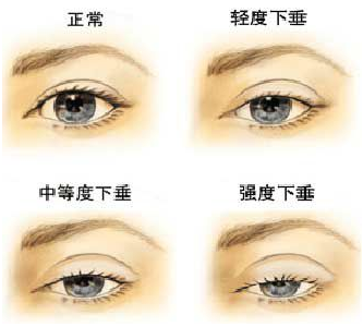 上瞼下垂的發生原因