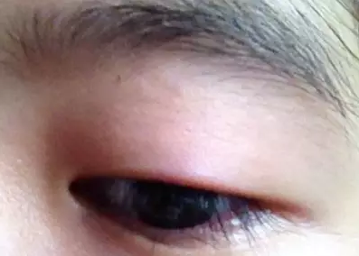 “美目貼”別依賴，小心眼皮下垂