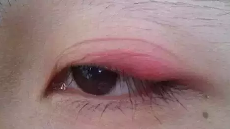 “美目貼”別依賴，小心眼皮下垂