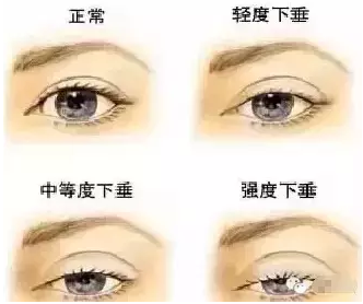 “美目貼”別依賴，小心眼皮下垂