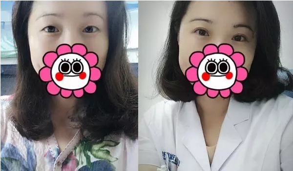要不要做雙眼皮？別糾結了看這個！