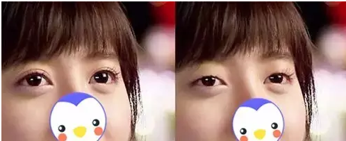 要不要做雙眼皮？別糾結了看這個！