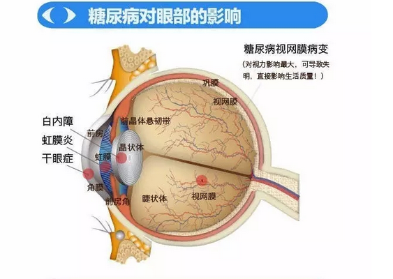 你造嗎？糖尿病晚期眼睛會致盲！