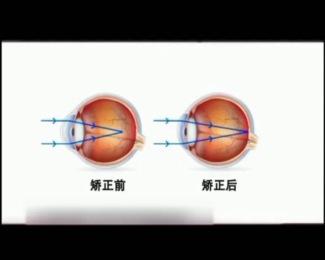 一夜之間真的能改變視力嗎？
