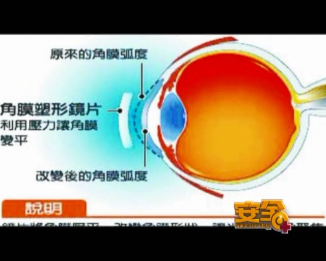 一夜之間真的能改變視力嗎？
