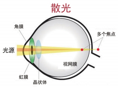 關于散光配鏡的兩大誤區