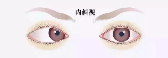 關于斜視，這幾個誤區害人不淺!