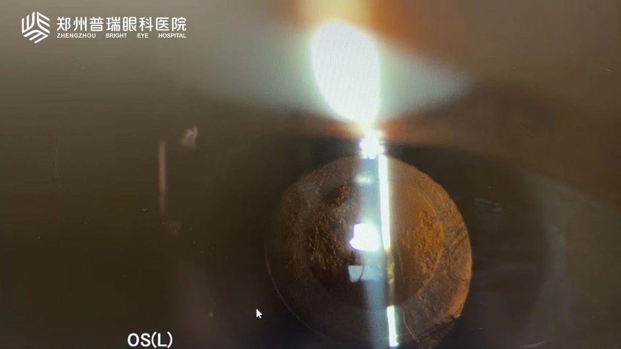 白內障術后視力又下降？6大原因多方面解析！